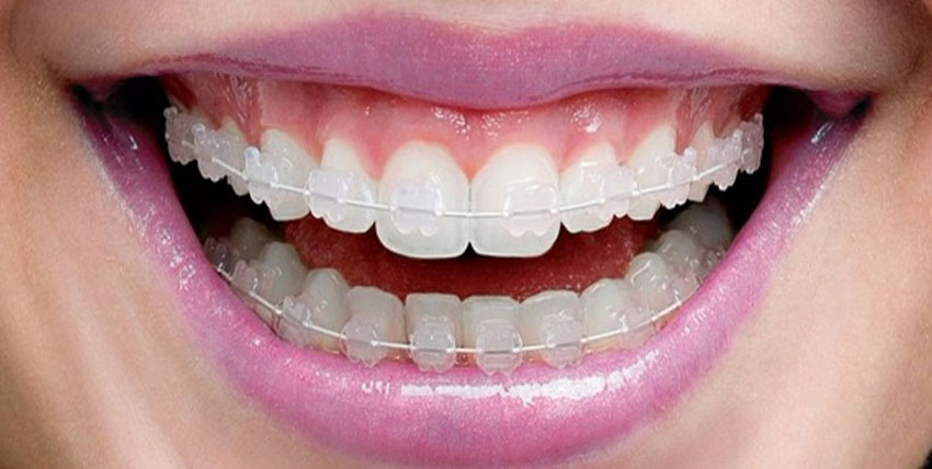 tooth-color-braces