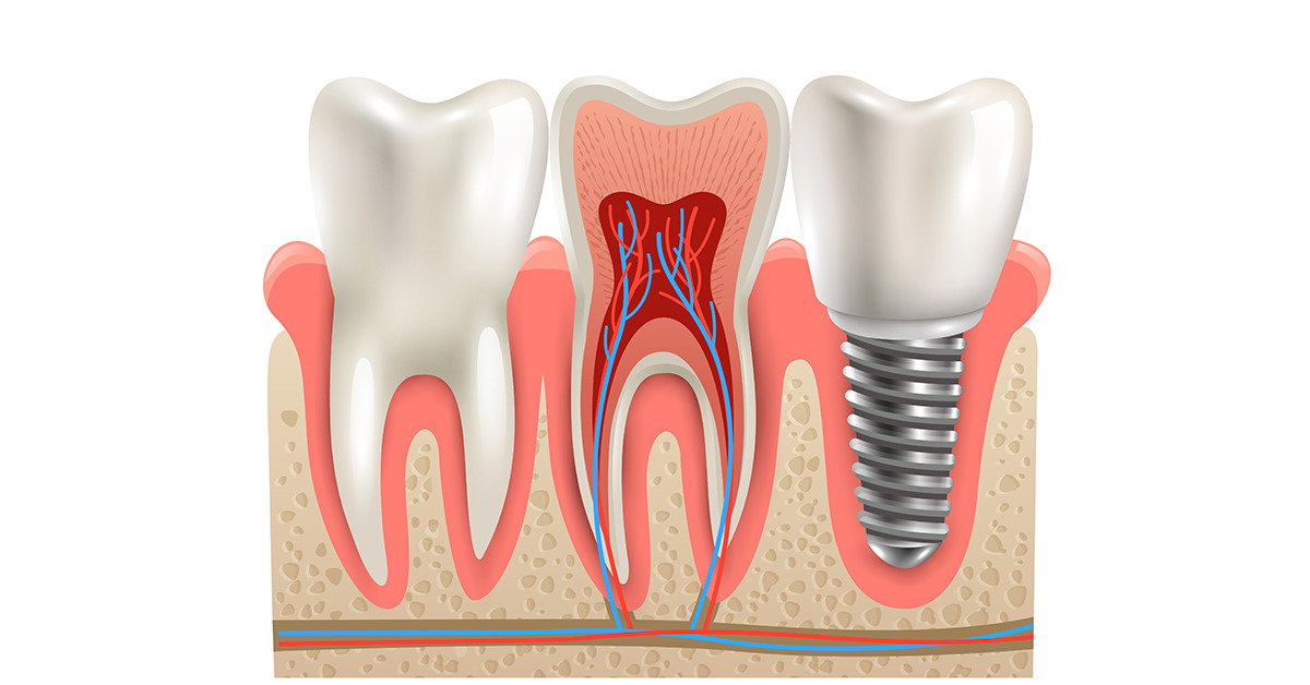 Dental Implants For All Age Groups-1