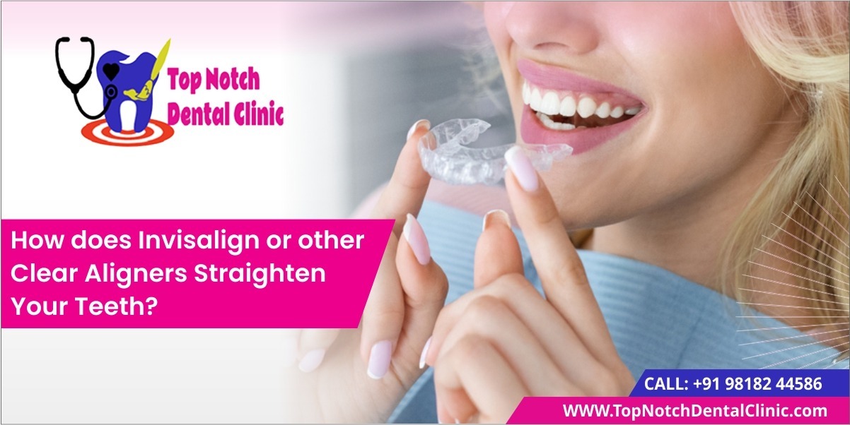 How does Invisalign or other Clear Aligners Straighten Your Teeth?