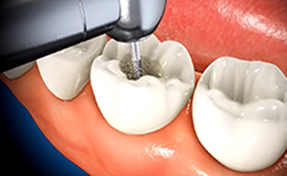 Best Root Canal Treatment in Delhi