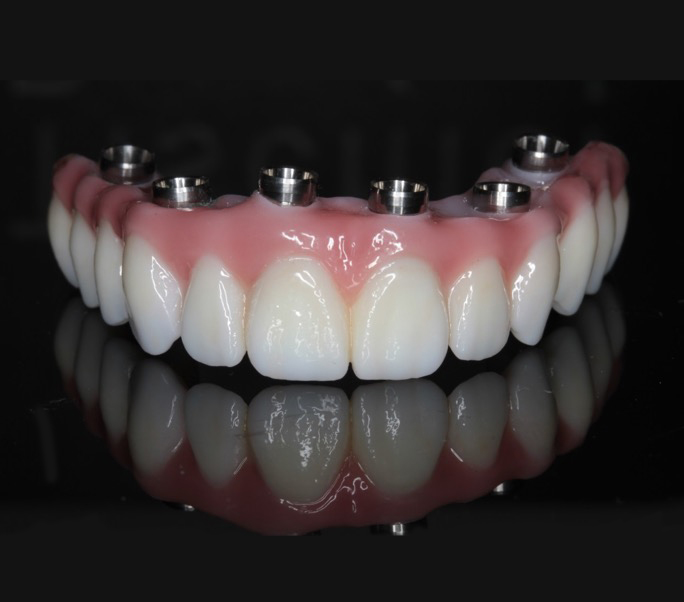 implant-denture