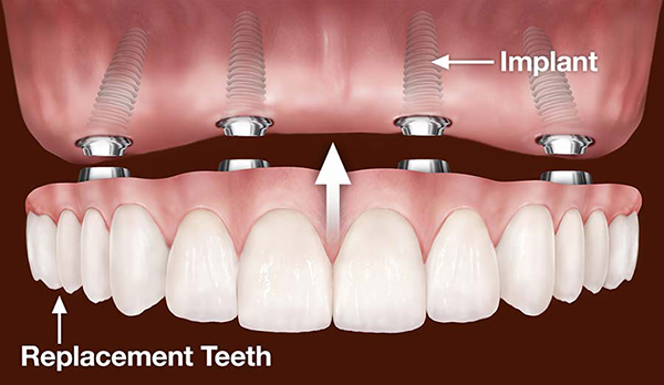 removable-implats-denture