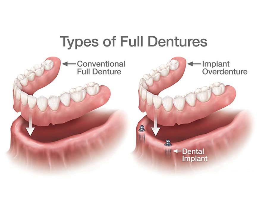 types-of-full-dentures